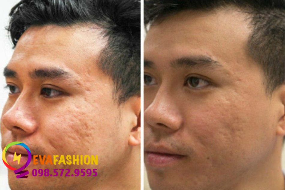 Trước và sau khi dùng kiên trì sản phẩm trị mụn sẹo Esunvy